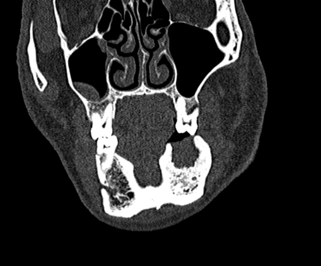 Ameloblastoma (Radiopaedia 51921-57766 Coronal bone window 64).jpg