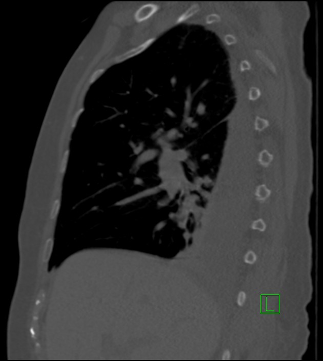Amiodarone deposition in the liver (Radiopaedia 77587-89780 Sagittal bone window 66).jpg