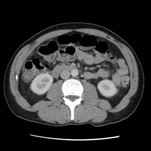 File:Amoebic liver abscesses (Radiopaedia 55536-62009 A 46).jpg