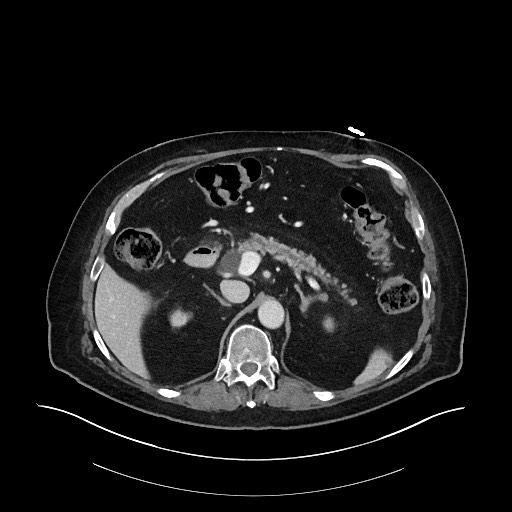 Ampullary adenocarcinoma (Radiopaedia 59373-66734 C 51).jpg