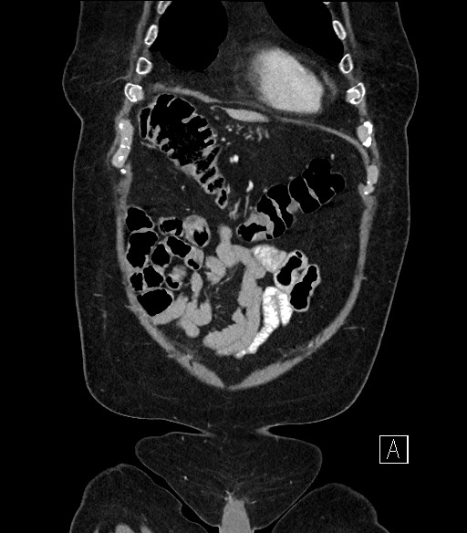 Ampullary adenocarcinoma (Radiopaedia 59373-66734 D 8).jpg
