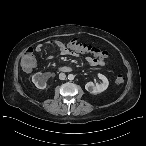 Ampullary adenocarcinoma (Radiopaedia 59373-66737 A 80).jpg