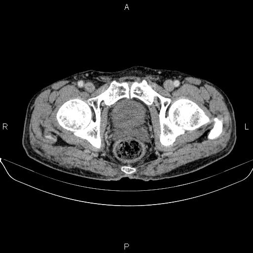 Ampullary adenocarcinoma (Radiopaedia 86093-102032 A 55).jpg