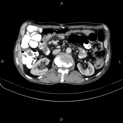 Ampullary adenocarcinoma (Radiopaedia 86093-102033 B 66).jpg