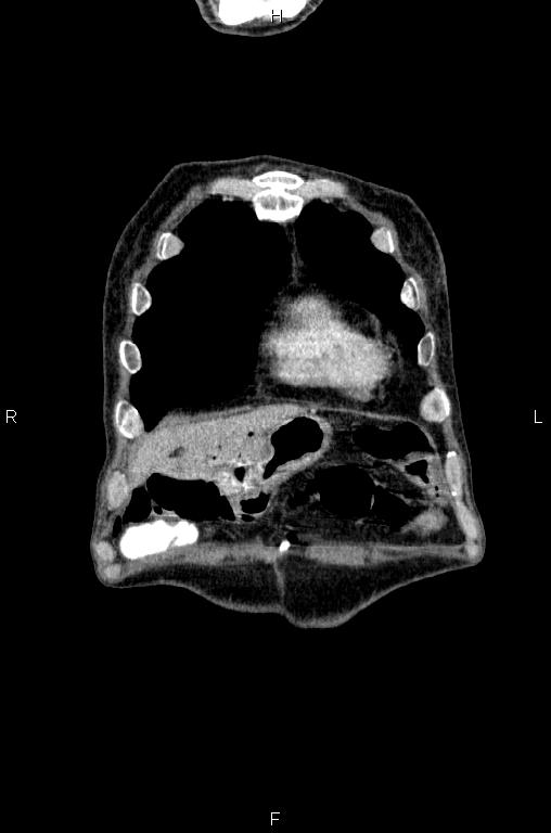 Ampullary adenocarcinoma (Radiopaedia 86093-102033 D 5).jpg