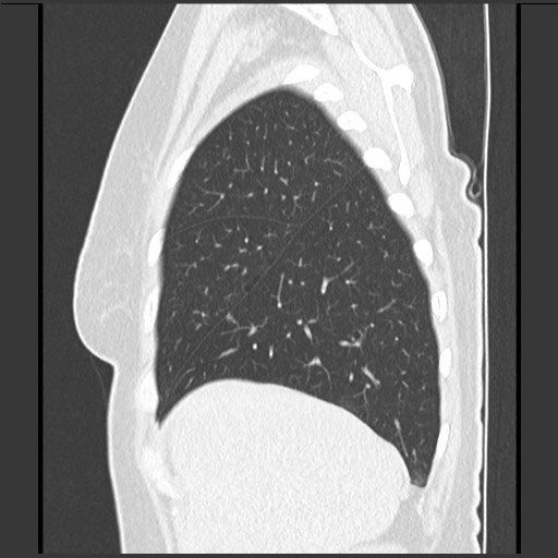 Amyloidosis - bronchial and diffuse nodular pulmonary involvement (Radiopaedia 60156-67744 F 11).jpg