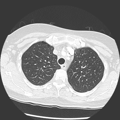 Amyloidosis - bronchial and diffuse nodular pulmonary involvement (Radiopaedia 60156-67745 Axial lung window 17).jpg