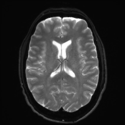 File:Amyotrophic lateral sclerosis (Radiopaedia 87352-103658 Axial DWI 16).jpg