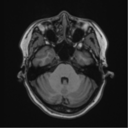File:Anaplastic astroblastoma (Radiopaedia 55666-62194 Axial T1 20).png
