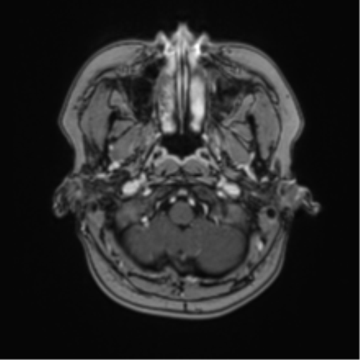 Anaplastic astroblastoma (Radiopaedia 55666-62194 Axial T1 C+ 8).png