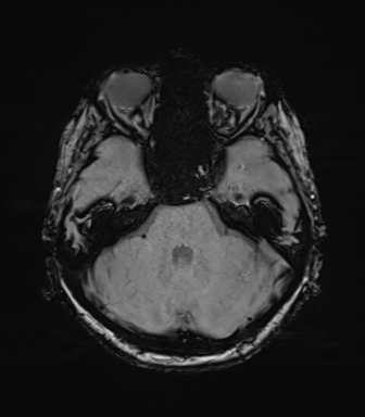 Anaplastic astrocytoma (Radiopaedia 86943-103160 Axial SWI 29).png