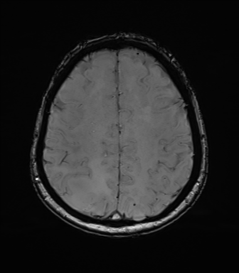Anaplastic astrocytoma (Radiopaedia 86943-103160 Axial SWI 65).png