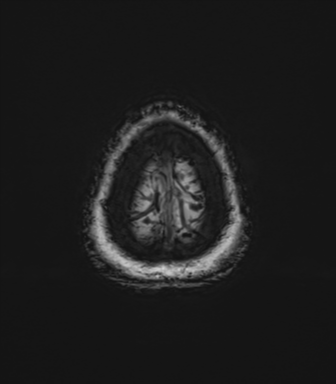 Anaplastic astrocytoma (Radiopaedia 86943-103160 Axial SWI 86).png
