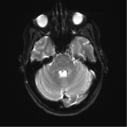 Anaplastic astrocytoma IDH mutant (Radiopaedia 50046-55341 Axial DWI 8).png