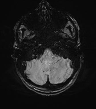 File:Anaplastic astrocytoma IDH mutant (Radiopaedia 50046-55341 Axial SWI 18).png