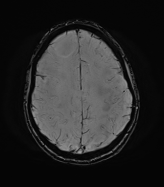 File:Anaplastic astrocytoma IDH mutant (Radiopaedia 50046-55341 Axial SWI 65).png