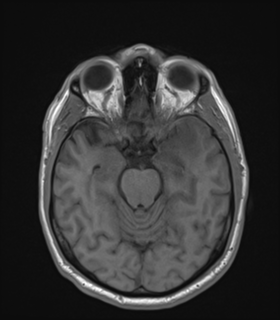 Anaplastic astrocytoma IDH wild-type (Radiopaedia 49984-55273 Axial T1 22).png