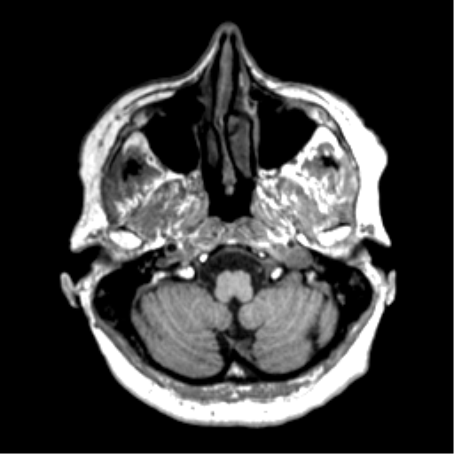 Anaplastic astrocytoma IDH wild-type (pseudoprogression) (Radiopaedia 42209-45277 Axial T1 18).png