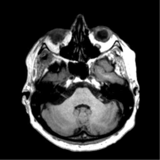 Anaplastic astrocytoma IDH wild-type (pseudoprogression) (Radiopaedia 42209-45277 Axial T1 31).png