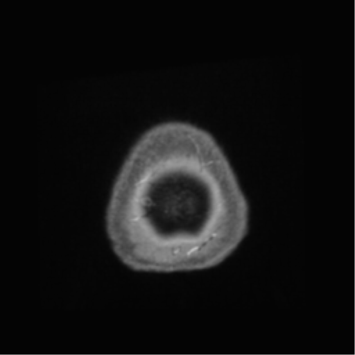 File:Anaplastic astrocytoma IDH wild-type (pseudoprogression) (Radiopaedia 42209-45278 Axial T1 C+ 152).png