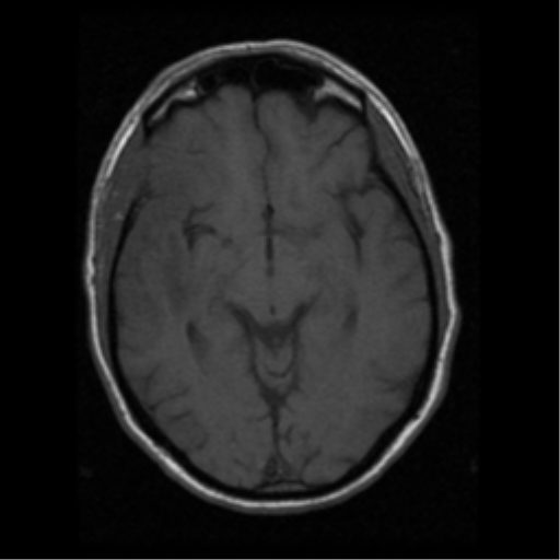 File:Anaplastic meningioma with recurrence (Radiopaedia 34452-35783 Axial T1 9).png