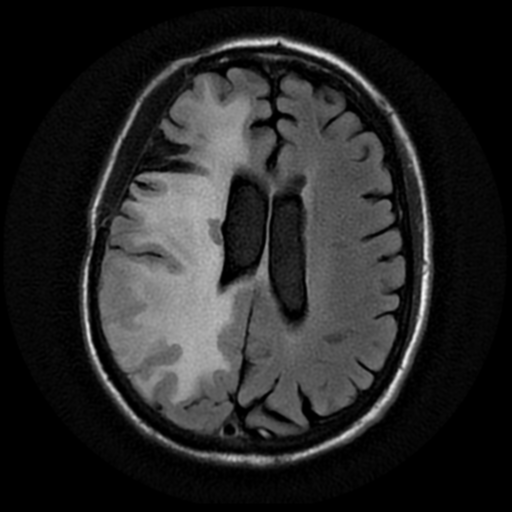 File:Anaplastic meningioma with recurrence (Radiopaedia 34452-35790 Axial T2 FLAIR 14).png