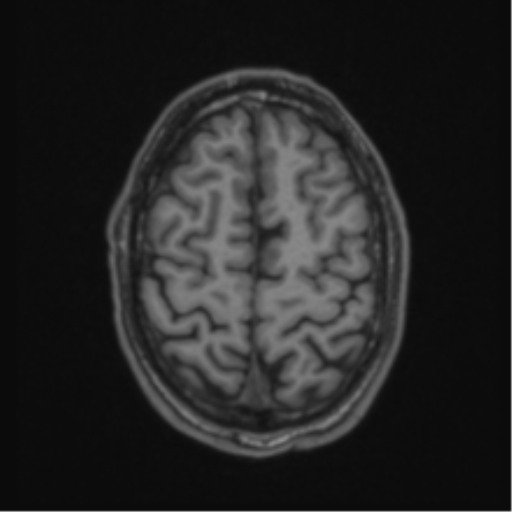 Anaplastic oligodendroglioma with skull fracture (Radiopaedia 74831-85845 Axial T1 54).png