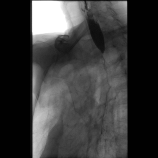 File:Anastomotic stricture post Ivor Lewis esophagectomy (Radiopaedia 47937-52715 F 7).png