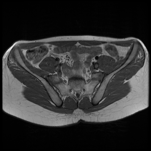 File:Androgen insensitivity syndrome (Radiopaedia 38585-40727 Axial T1 4).jpg