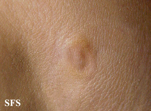 Anetoderma Jadassohn Pellizari (Dermatology Atlas 16).jpg