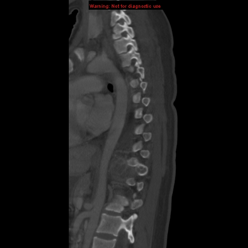 File:Aneurysmal bone cyst (Radiopaedia 9419-10102 Sagittal bone window 13).jpg