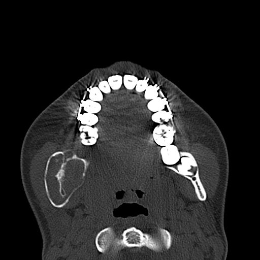 File:Aneurysmal bone cyst of the mandible (Radiopaedia 43280-46601 Axial bone window 35).jpg