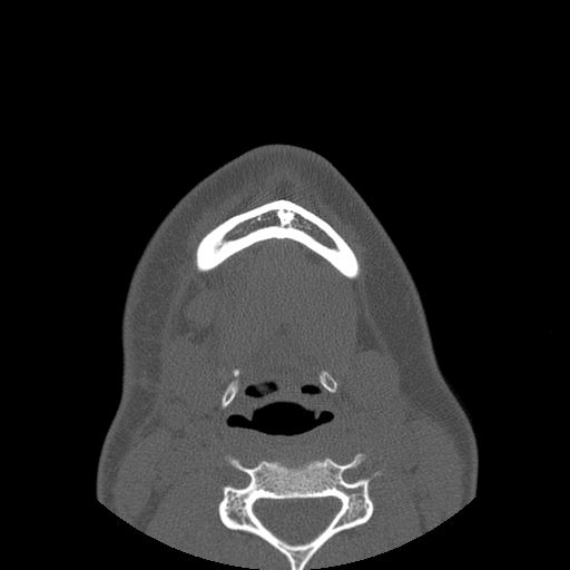 Aneurysmal bone cyst of the mandible (Radiopaedia 43280-46823 Axial bone window 14).jpg