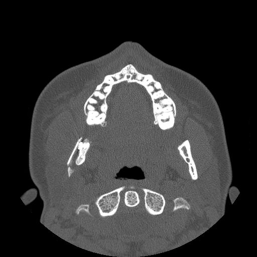Aneurysmal bone cyst of the mandible (Radiopaedia 43280-46823 Axial bone window 87).jpg