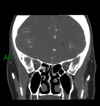 Aneurysmal subarachnoid hemorrhage with intra-axial extension (Radiopaedia 84371-99732 C 69).jpg