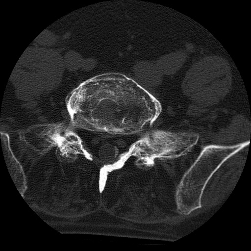 File:Ankylosing spondylitis complicated by fracture-dislocation (Radiopaedia 33583-34674 Axial non-contrast 141).jpg