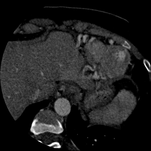 File:Anomalous left coronary artery from the pulmonary artery (ALCAPA) (Radiopaedia 40884-43586 A 81).jpg
