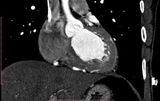 Anomalous left coronary artery from the pulmonary artery (ALCAPA) (Radiopaedia 70148-80181 B 144).jpg