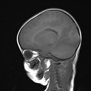 File:Anoxic brain injury (Radiopaedia 79165-92139 Sagittal T1 13).jpg