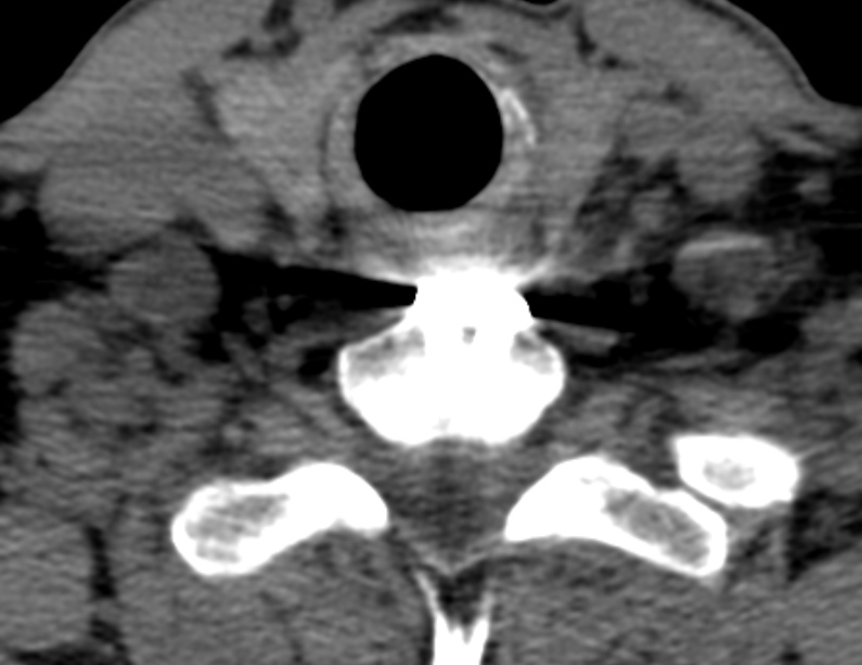 Anterior cervical postdiscectomy arthrodesis (Radiopaedia 32678-33646 Axial non-contrast 62).jpg