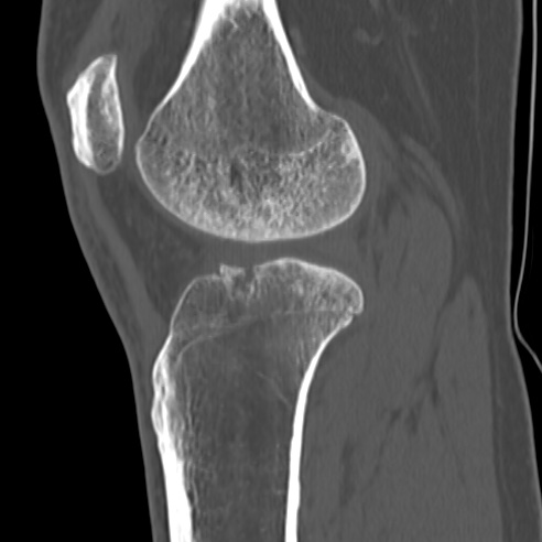 File:Anterior cruciate ligament avulsion fracture (Radiopaedia 58939-66194 Sagittal bone window 14).jpg