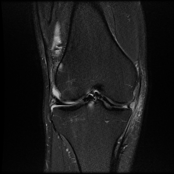 File:Anterior cruciate ligament graft tear and bucket-handle tear of medial meniscus (Radiopaedia 75867-87255 Coronal PD fat sat 13).jpg