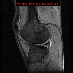 File:Anterior cruciate ligament injury - partial thickness tear (Radiopaedia 12176-12515 A 14).jpg