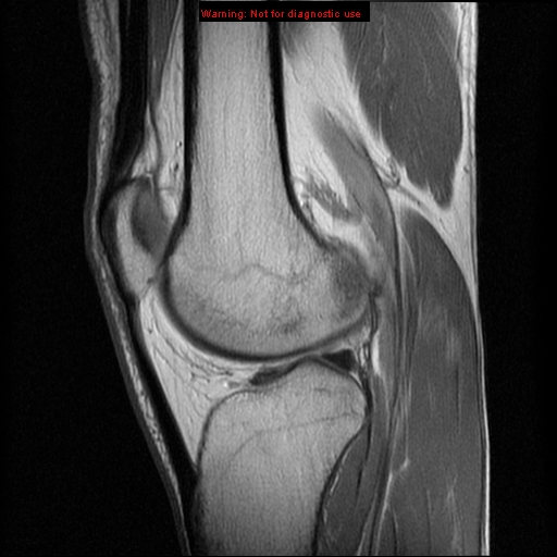 File:Anterior cruciate ligament injury - partial thickness tear (Radiopaedia 12176-12515 Sagittal PD 12).jpg