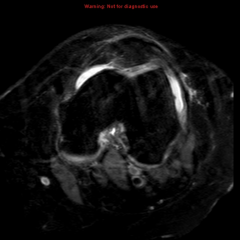 File:Anterior cruciate ligament tear (Radiopaedia 12329-12612 Axial T2 fat sat 14).jpg