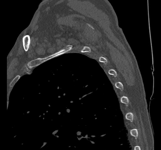 File:Anterior glenohumeral dislocation with Hill-Sachs lesion (Radiopaedia 62877-71249 Sagittal bone window 61).jpg