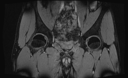 Anterior inferior iliac spine avulsion fracture (Radiopaedia 81312-95000 G 54).jpg