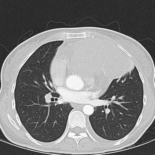 Anterior mediastinal lymphoma (Radiopaedia 29556-30061 Axial lung window 31).jpg