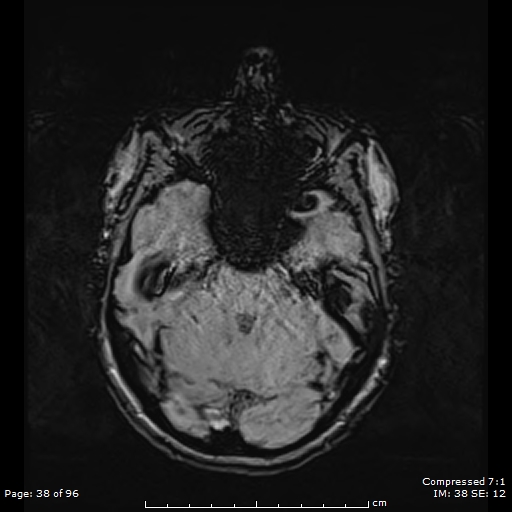 Anterior temporal lobe perivascular space (Radiopaedia 88283-104914 Axial SWI 7).jpg
