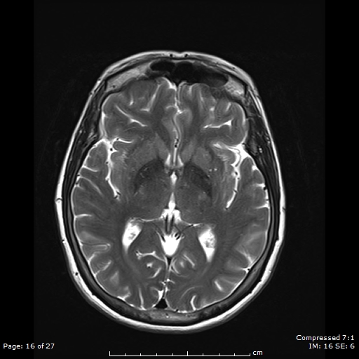 File:Anterior temporal lobe perivascular space (Radiopaedia 88283-104914 Axial T2 16).jpg